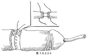 阴茎重建术